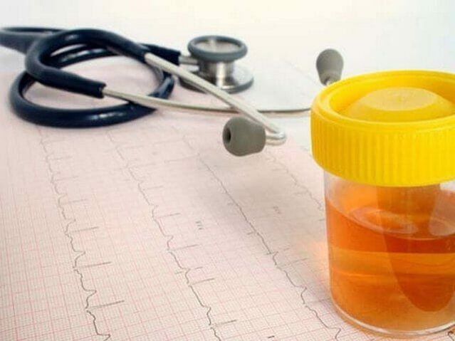 analyse d'urine pour diagnostiquer une cystite